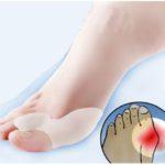 Hallux Valgus Siliconen Teencorrector/Spreider -0