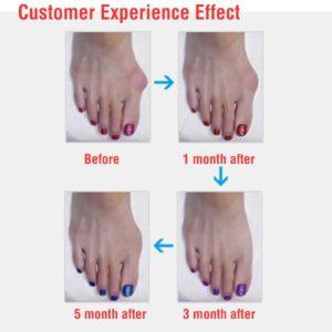 Hallux Valgus Siliconen Teencorrector/Spreider -224
